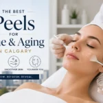 Best Peels for Acne and Aging in Calgary